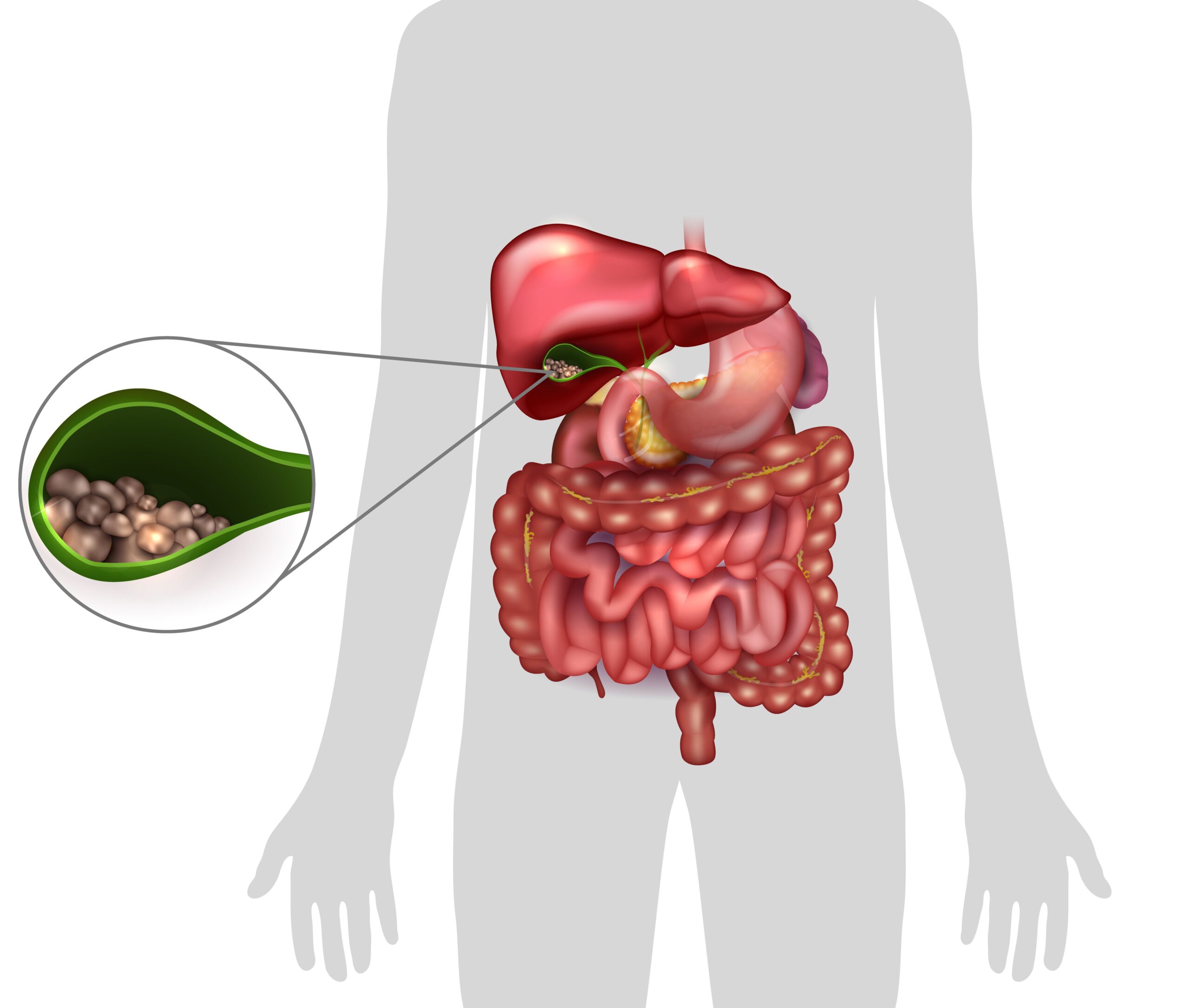 Gall Bladder Stone Removal and Surgery in Ahmedabad