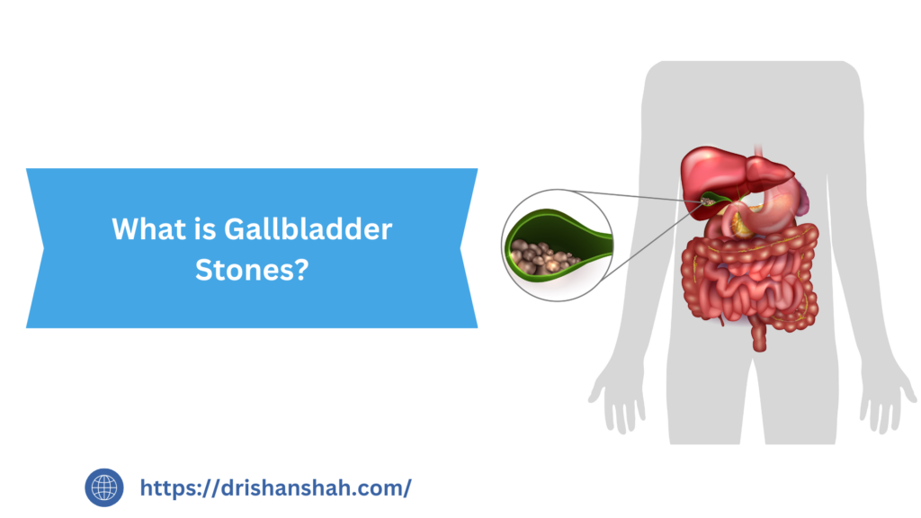 What is Gallbladder Stones?