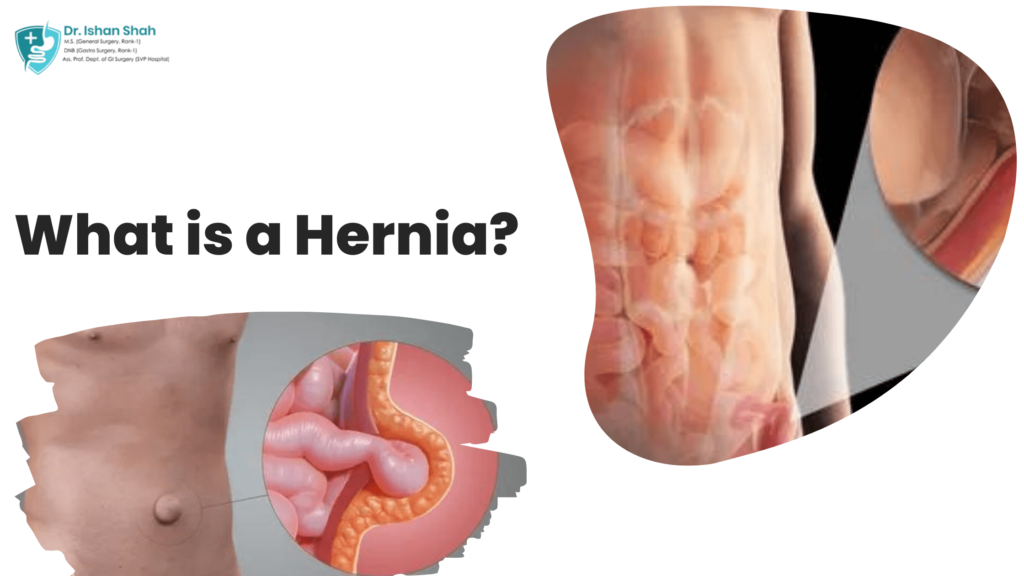 What is a Hernia?