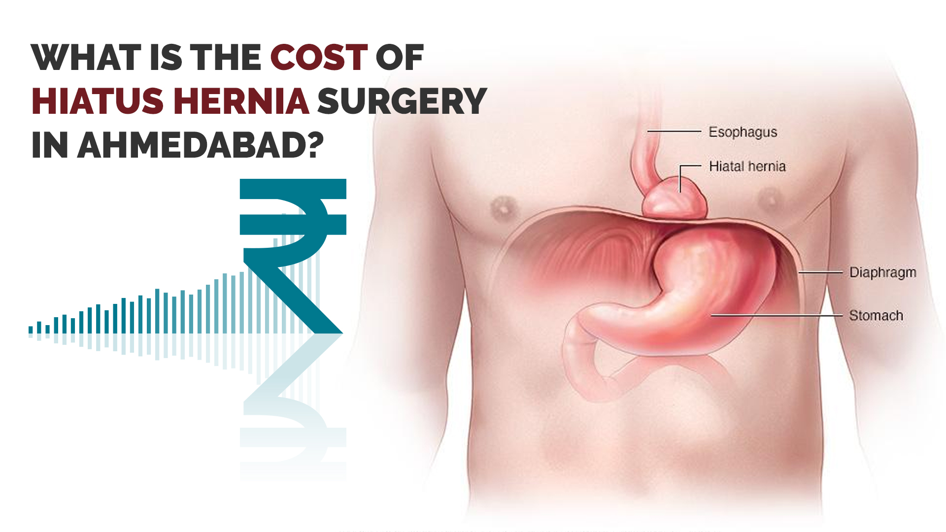 Understanding the Cost of Hiatus Hernia Surgery in Ahmedabad