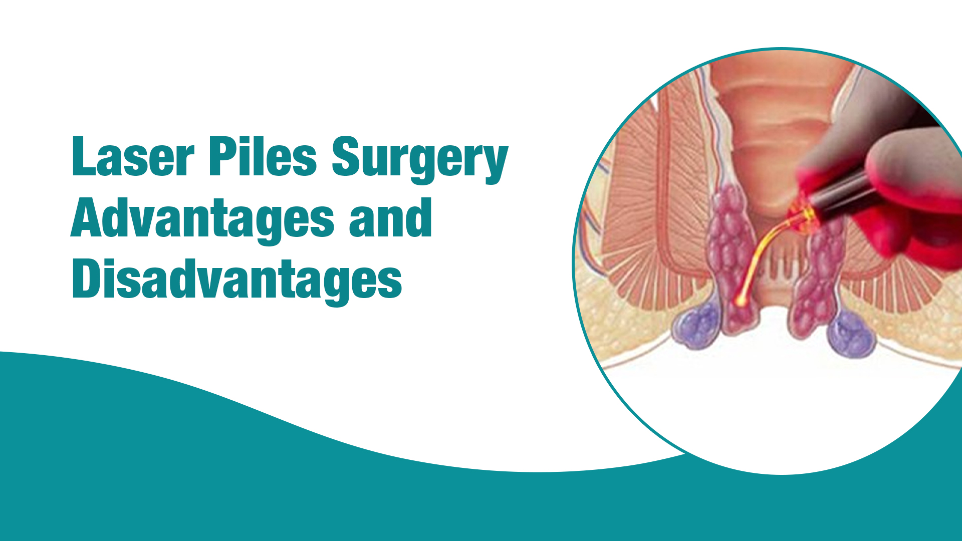 Laser Piles Surgery Advantages and Disadvantages